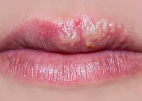 Herpes Labiale I Concetti Chiave Dei Rimedi Piu Indicati