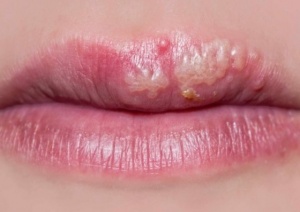 Herpes labiale: i concetti chiave dei rimedi più indicati